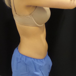 CoolSculpting Before & After Patient #278