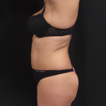 CoolSculpting Before & After Patient #284