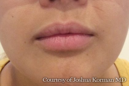 Juvederm Before & After Patient #290