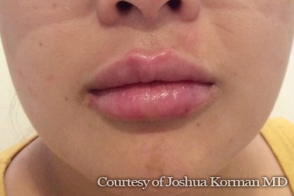 Juvederm Before & After Patient #290