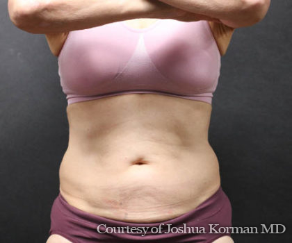 CoolSculpting Before & After Patient #288