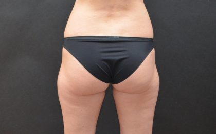 CoolSculpting Before & After Patient #287