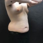 EMSculpt Neo Before & After Patient #751