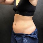 CoolSculpting Before & After Patient #747