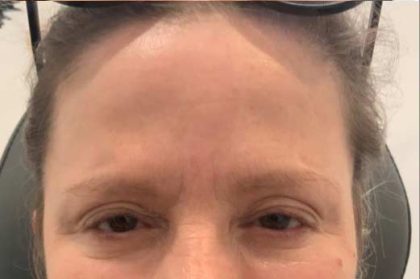 Botox / Dysport Before & After Patient #612