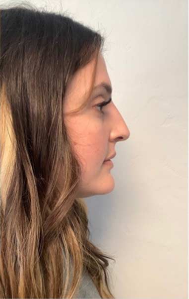 Restylane Before & After Patient #658