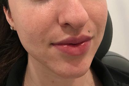 Juvederm Before & After Patient #660