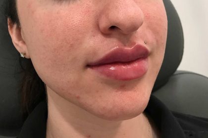 Juvederm Before & After Patient #660