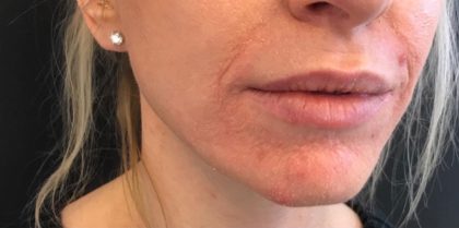 Restylane Before & After Patient #582