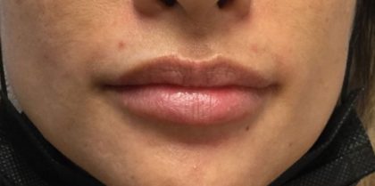 Restylane Before & After Patient #584