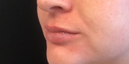 Restylane Before & After Patient #578