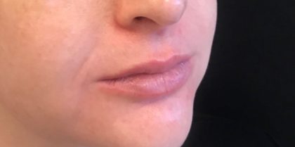 Restylane Before & After Patient #579