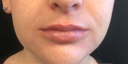 Restylane Before & After Patient #581