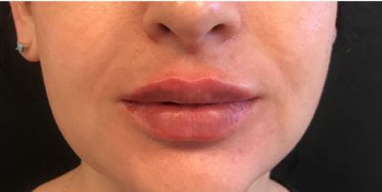 Restylane Before & After Patient #581