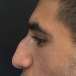 Liquid Rhinoplasty Before & After Patient #670