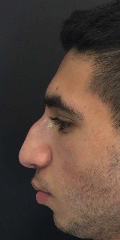 Liquid Rhinoplasty Before & After Patient #670